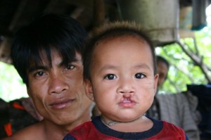 High mortality among infants with birth defects.  Vieng’s mother struggled to keep him alive.