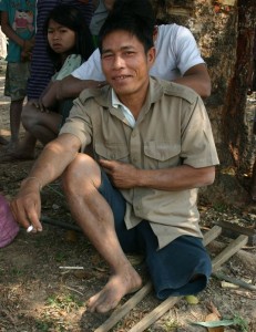 Too poor to pay for care, this man eventually lost his leg to snakebite infection.